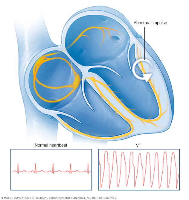 ventricular-heartbeat-8col