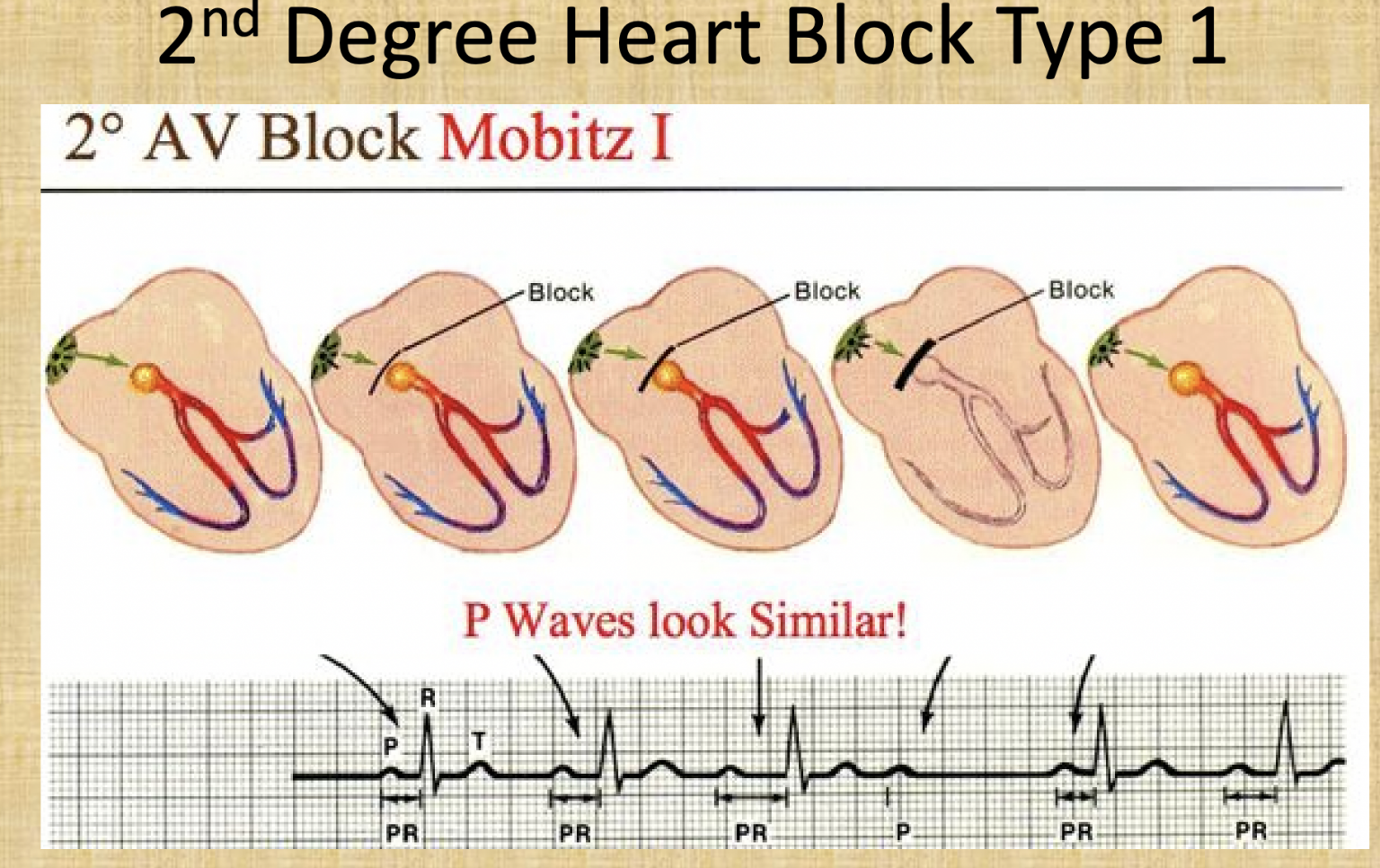 ACLS Cardiac EKG Arrhythmias and Treatments Cheat Sheet